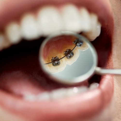 Close-up of woman having lingual braces check-up by orthodontist at dentist's office.