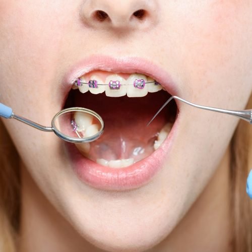 Cropped shot of dentist in latex gloves using a mouth mirror and periodontal probe on woman with