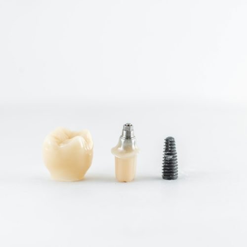 Dental implant with screw and crown